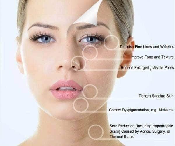 microneedling banbury