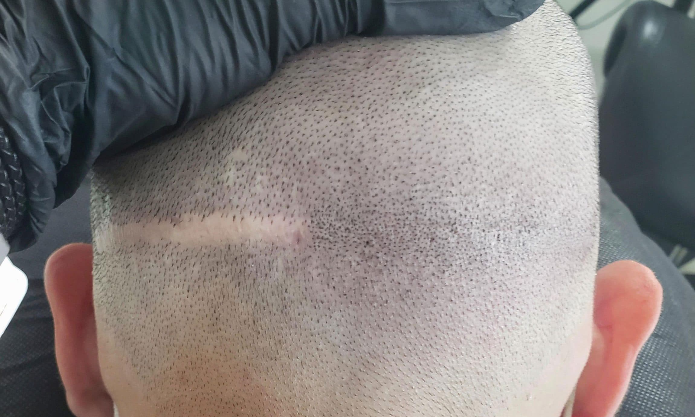 scalp micropigmentation scar camouflage banbury
